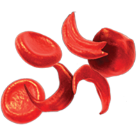 Glóbulos rojos falciformes